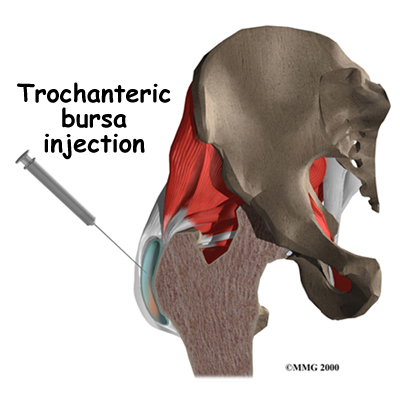hip_trochburs_diagnosis01