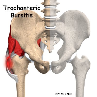 hip_trochburs_intro01