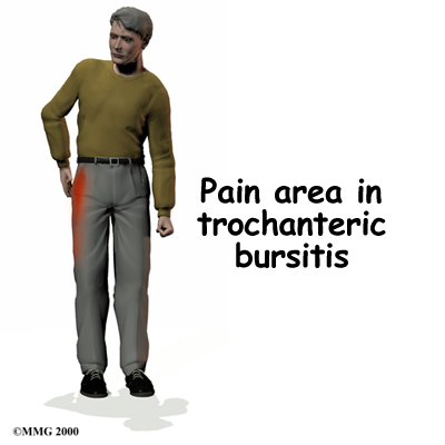hip_trochburs_symptom01