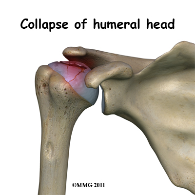 humeral_head_osteonecrosis_collapse