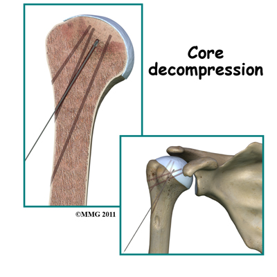 humeral_head_osteonecrosis_core_decompression_multi
