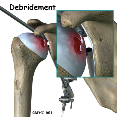 humeral_head_osteonecrosis_debridement