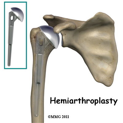 humeral_head_osteonecrosis_hemiarthroplasty