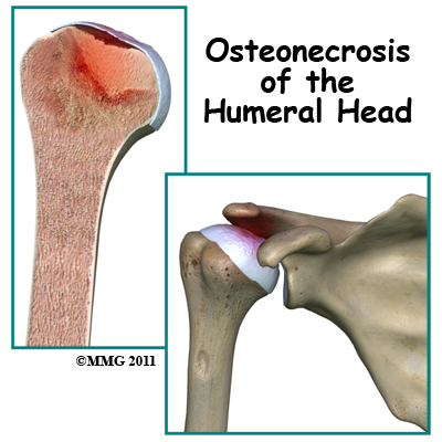 humeral_head_osteonecrosis_intro