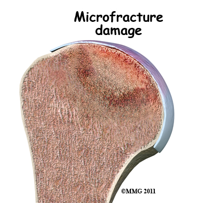 humeral_head_osteonecrosis_microfracture_damage