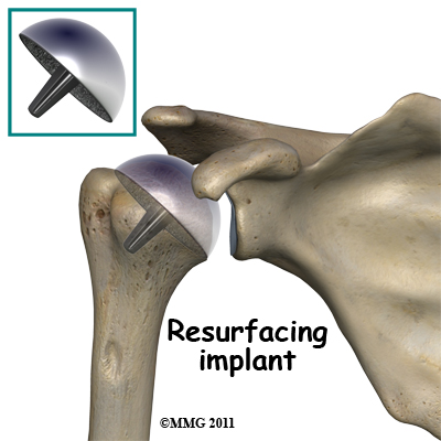 humeral_head_osteonecrosis_resurfacing