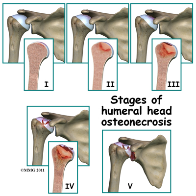 humeral_head_osteonecrosis_stages