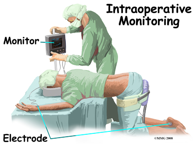 intraop_monitoring_method01