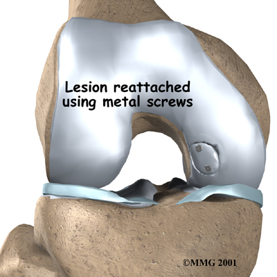 knee_OCD_surgery01