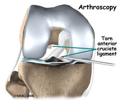 knee_acl_diagnosis03