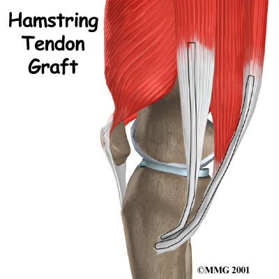 knee_acl_hamstring_tendon_intro02