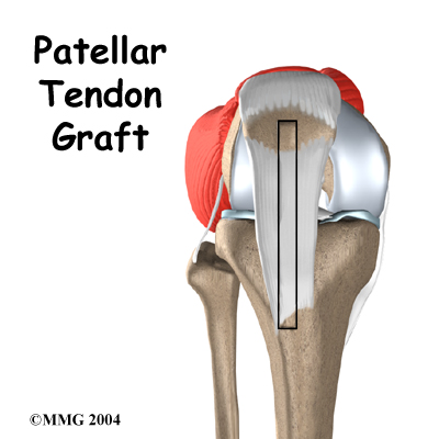 knee_acl_patellar_tendon_intro02