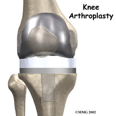 knee_arthroplasty_intro01