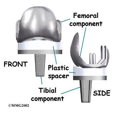 Central Orthopedic GroupArtificial Joint Replacement of the Knee | LI ...