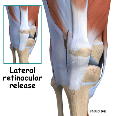 Central Orthopedic GroupBipartite Patellar in Children - Central ...