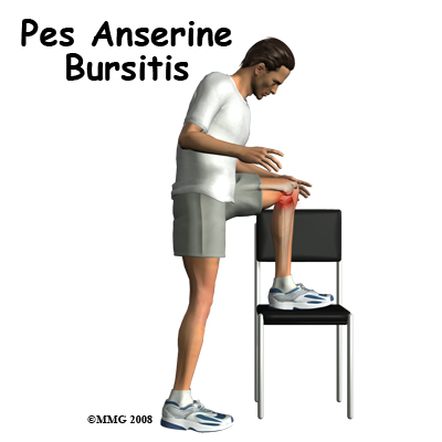 knee_bursitis_pes_anserine_intro01