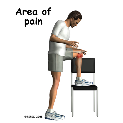 knee_bursitis_pes_anserine_symptom01