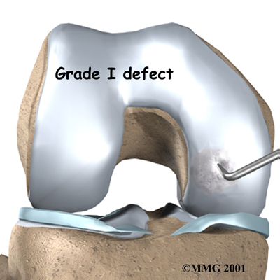 knee_cart_surg_anatomy02