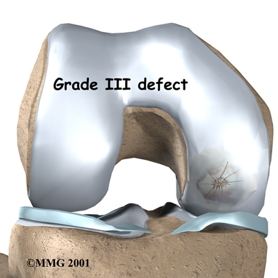knee_cart_surg_anatomy04