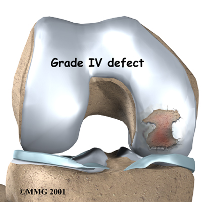 knee_cart_surg_anatomy05
