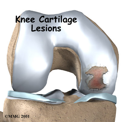knee_cart_surg_intro01
