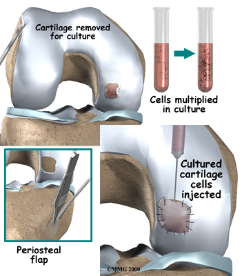 knee_cart_surg_treatment04
