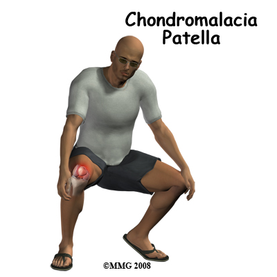 knee_chondromalacia_intro01
