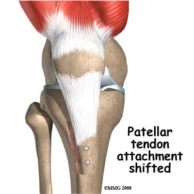 knee_chondromalacia_surgery01