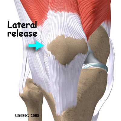 knee_chondromalacia_surgery02