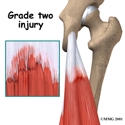 knee_hamstring_diagnosis02