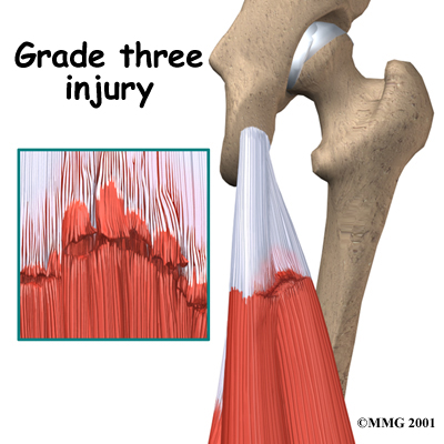 knee_hamstring_diagnosis03