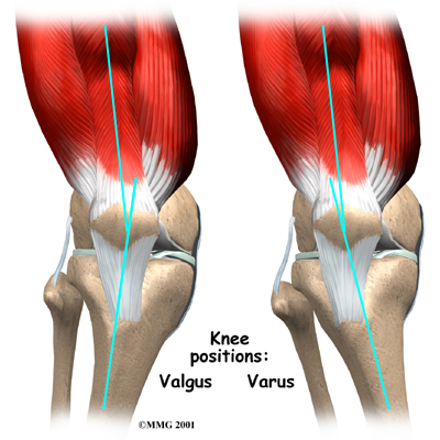 knee_itb_cause01