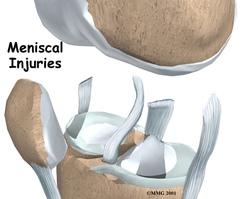 knee_meniscus_intro01