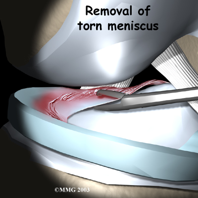 knee_meniscus_surgery02