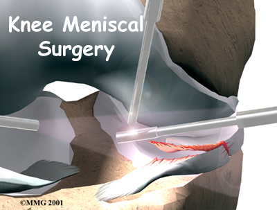 knee_meniscus_surgery_intro01