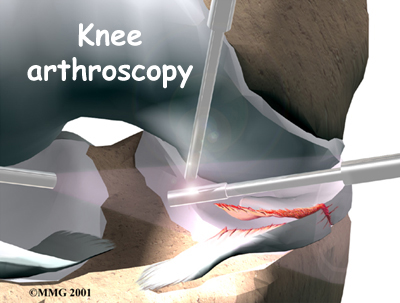 knee_meniscus_treatment01
