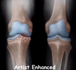 knee_osteoarth_diagnosis01