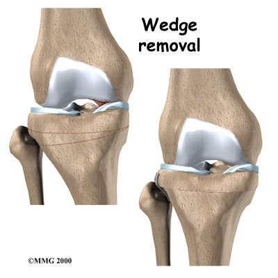 knee_osteoarth_surgery02a