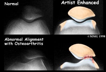 knee_patella_diagnosis01