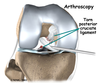 knee_pcl_diagnosis02