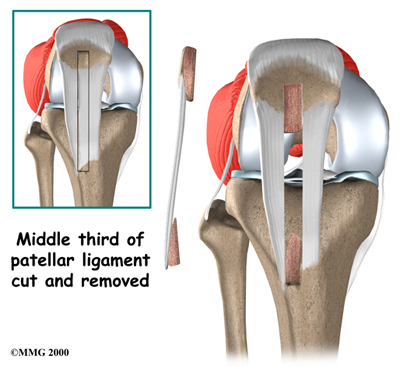knee_pcl_surgery01