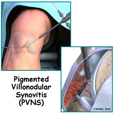 knee_pigmented_villonodular_synovitis_arthroscopy