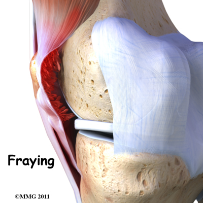 knee_pigmented_villonodular_synovitis_cause