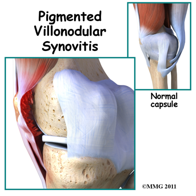 knee_pigmented_villonodular_synovitis_intro