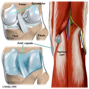 knee_popcyst_cause01