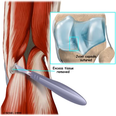 knee_popcyst_surgery01