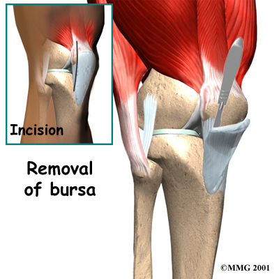 knee_prepatellar_surgery01