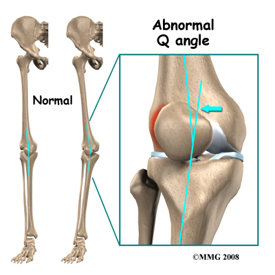 knee_tendonitis_patella_Qangle