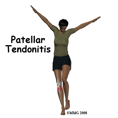knee_tendonitis_patella_intro01