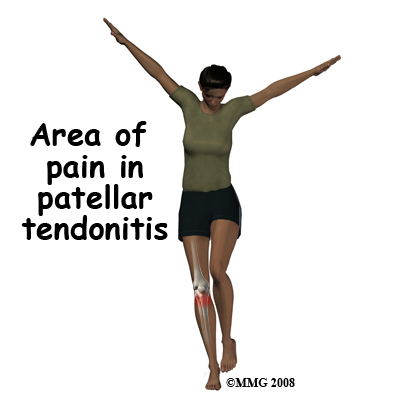 knee_tendonitis_patella_symptom01